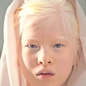 Girl abandoned at birth for her looks wants to prove the world wrong – she now models for Vogue