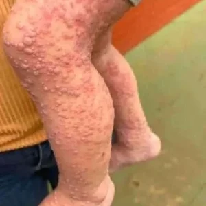 Her Whole Body Was Itchy: What She Thought Was a Common Allergy Was Hiding Something More Serious
