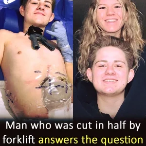 19-year-old crushed by forklift chooses to amputate bottom half of his body
