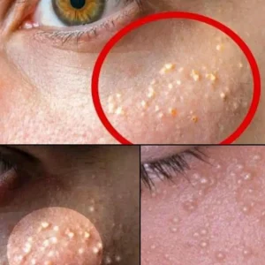 White Bumps on the Skin: Causes, Natural Solution, and Practical Tips