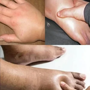 Get Rid of Swollen Hands & Feet Fast: Home Remedies for Water Retention