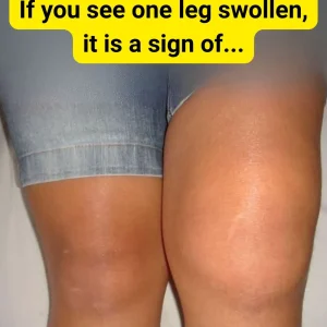 Why Is One Knee Swollen but Not the Other?