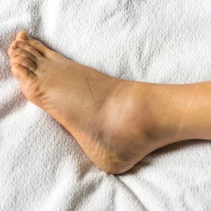 Why do ankles swell? How can you prevent it?