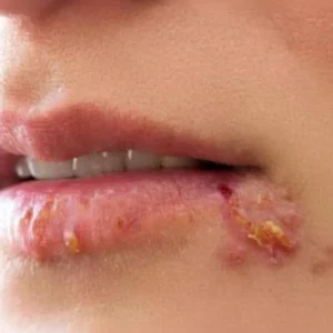If you see this appearing on your lips, it is a sign of ca….