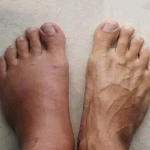 Swollen feet: a sign you shouldn’t ignore