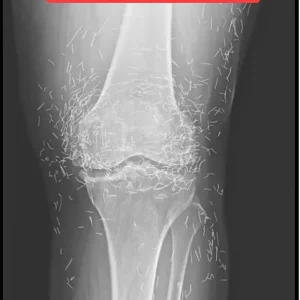 X-Ray Reveals Hundreds of Gold Needles in Woman’s Knees