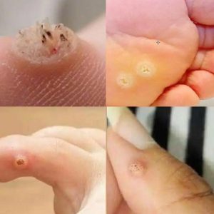Be Very Careful: If You Notice This Skin Growth, It Could Be Serious