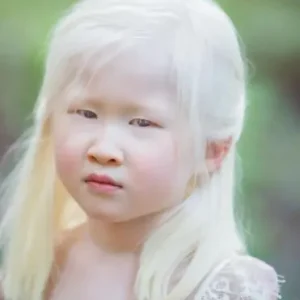 A baby girl born with albinism was abandoned by her parents, She looked too weird for them and left her at an orphanage door