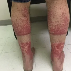 The Silent Skin Sign You Should Never Ignore: What That Net-Like Rash Could Really Mean