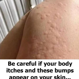 Why do hives appear on the skin? These are the surprising factors you might not know about.