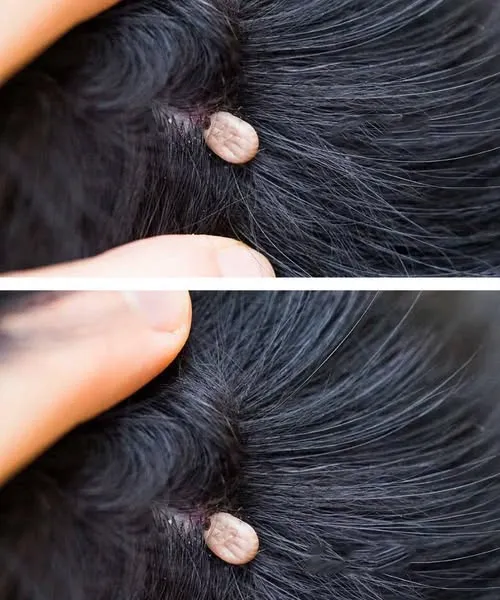Strange Finding in My Child’s Hair