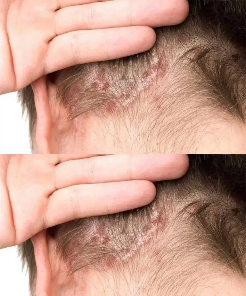 Found This on My Son’s Scalp and Couldn’t Get a Doctor’s Appointment — Here’s What Every Parent Should Know Before Panicking