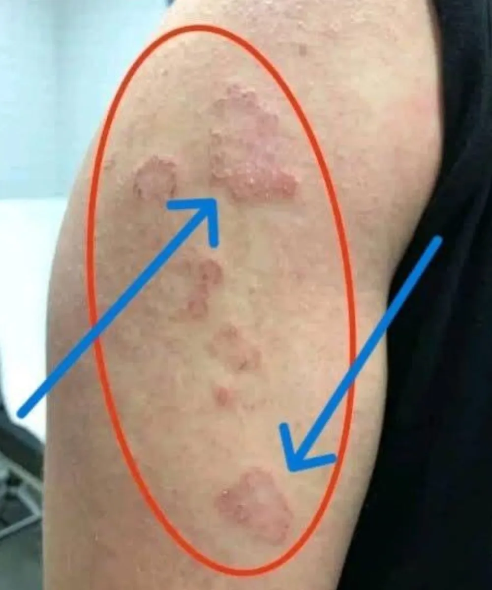 Is That Red Circular Rash On Your Arm Actually Highly Contagious