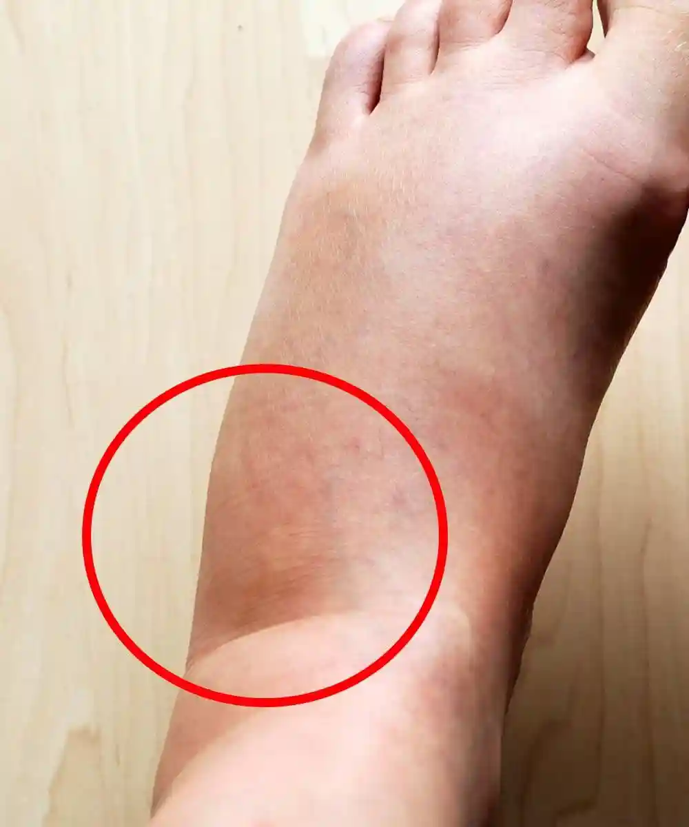 Discover Natural Herbal Solutions To Relieve Painful Swollen Feet Today